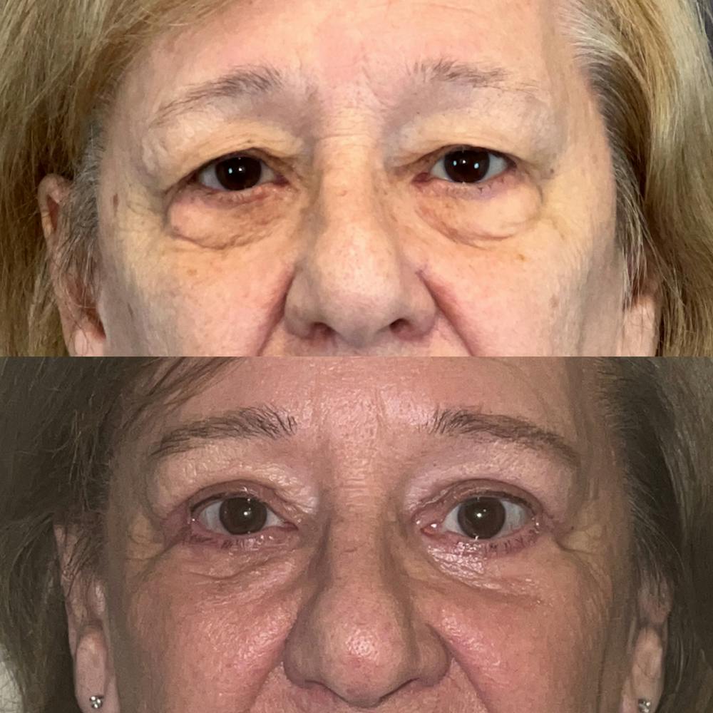 Lower Blepharoplasty Before & After Gallery - Patient 150585053 - Image 1