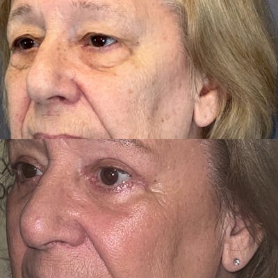 Upper Blepharoplasty Before & After Gallery - Patient 150585052 - Image 2