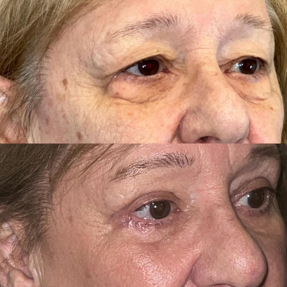 Upper Blepharoplasty Before & After Gallery - Patient 150585052 - Image 3