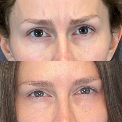 BOTOX Before & After Gallery - Patient 150585073 - Image 1