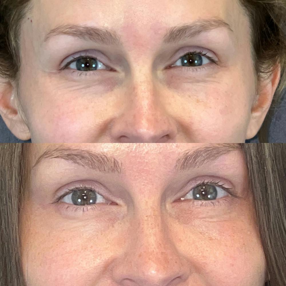 BOTOX Before & After Gallery - Patient 150585073 - Image 2