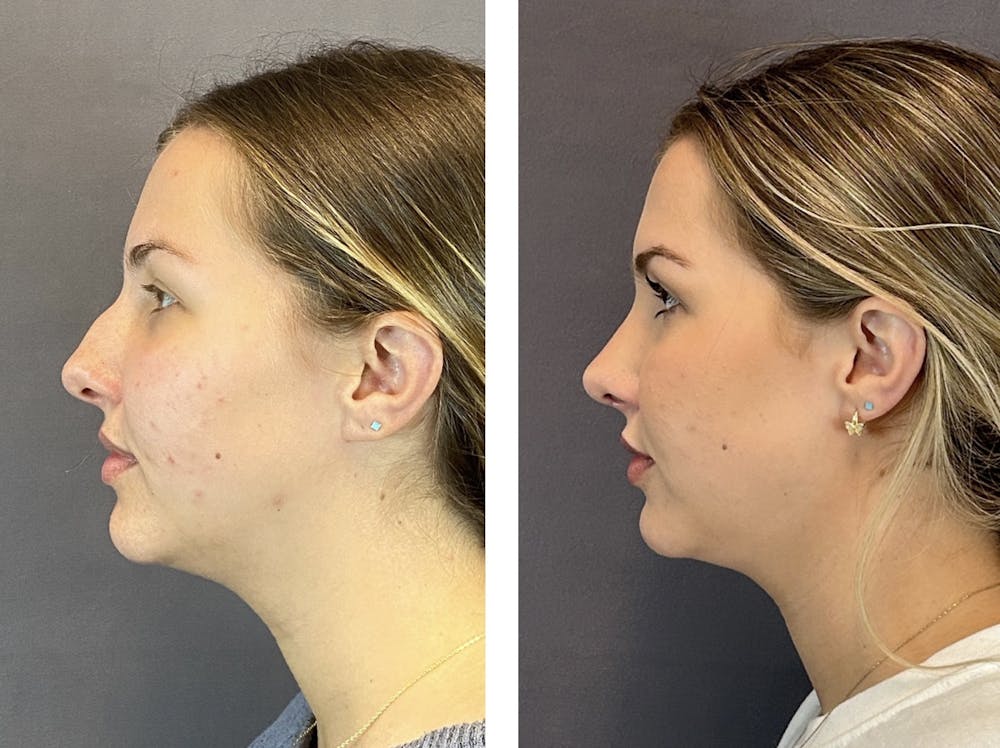 Rhinoplasty Before & After Gallery - Patient 152662239 - Image 5