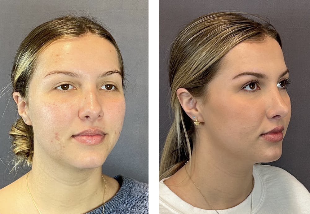 Rhinoplasty Before & After Gallery - Patient 152662239 - Image 2
