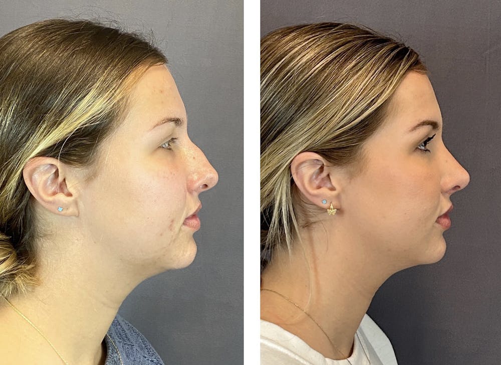 Rhinoplasty Before & After Gallery - Patient 152662239 - Image 1