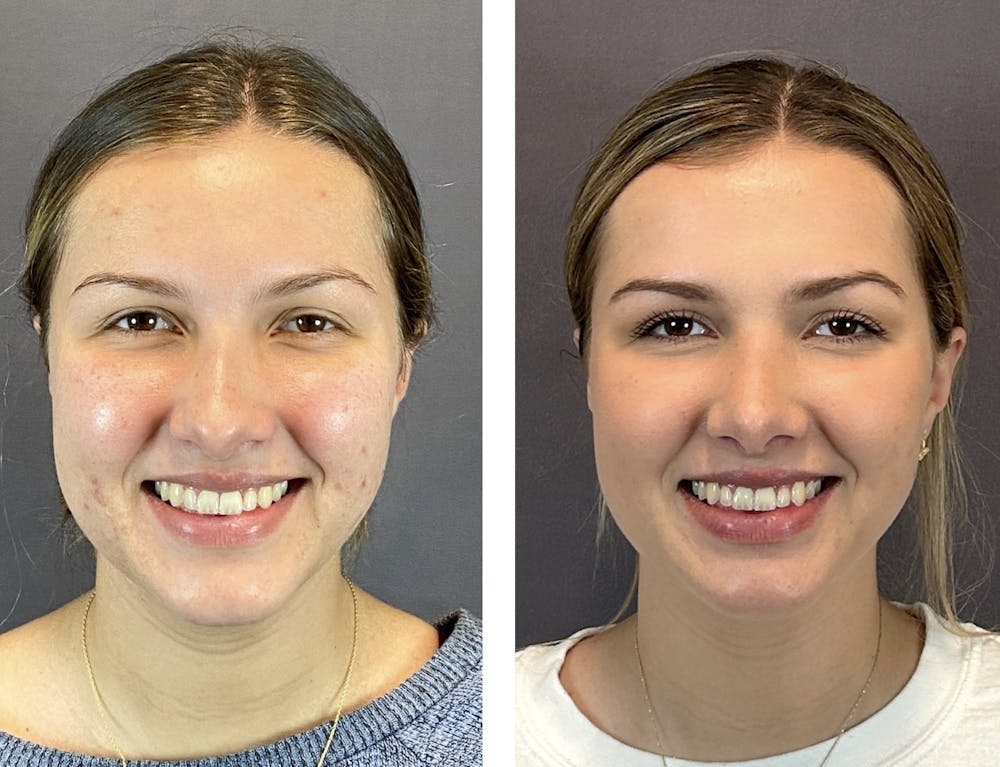 Rhinoplasty Before & After Gallery - Patient 152662239 - Image 3