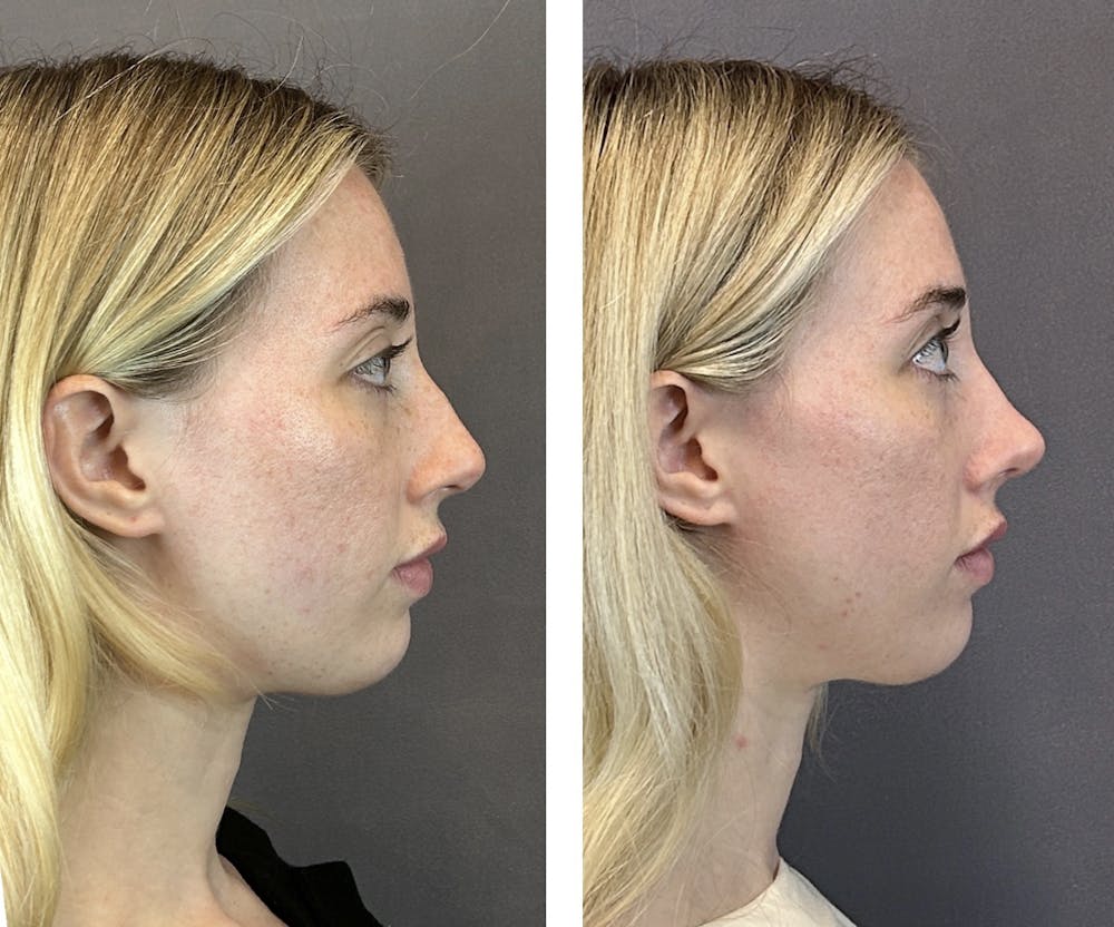 Rhinoplasty Before & After Gallery - Patient 152662238 - Image 1