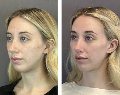 Rhinoplasty Before & After Gallery - Patient 152662238 - Image 4