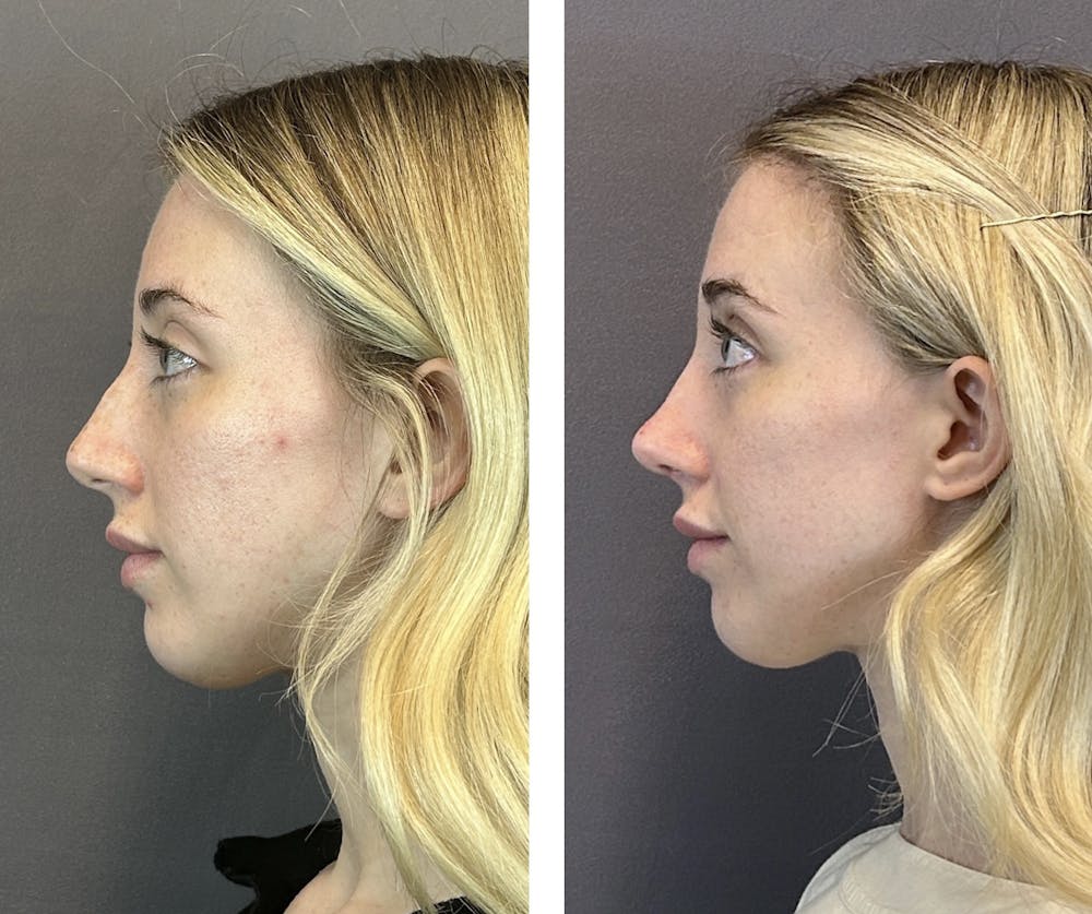 Rhinoplasty Before & After Gallery - Patient 152662238 - Image 5