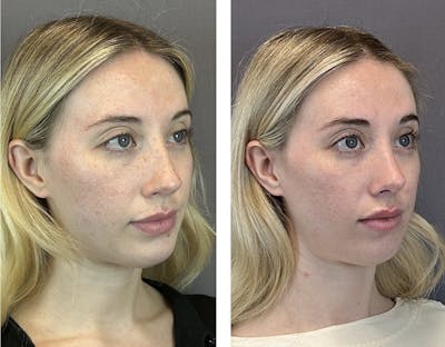 Rhinoplasty Before & After Gallery - Patient 152662238 - Image 2