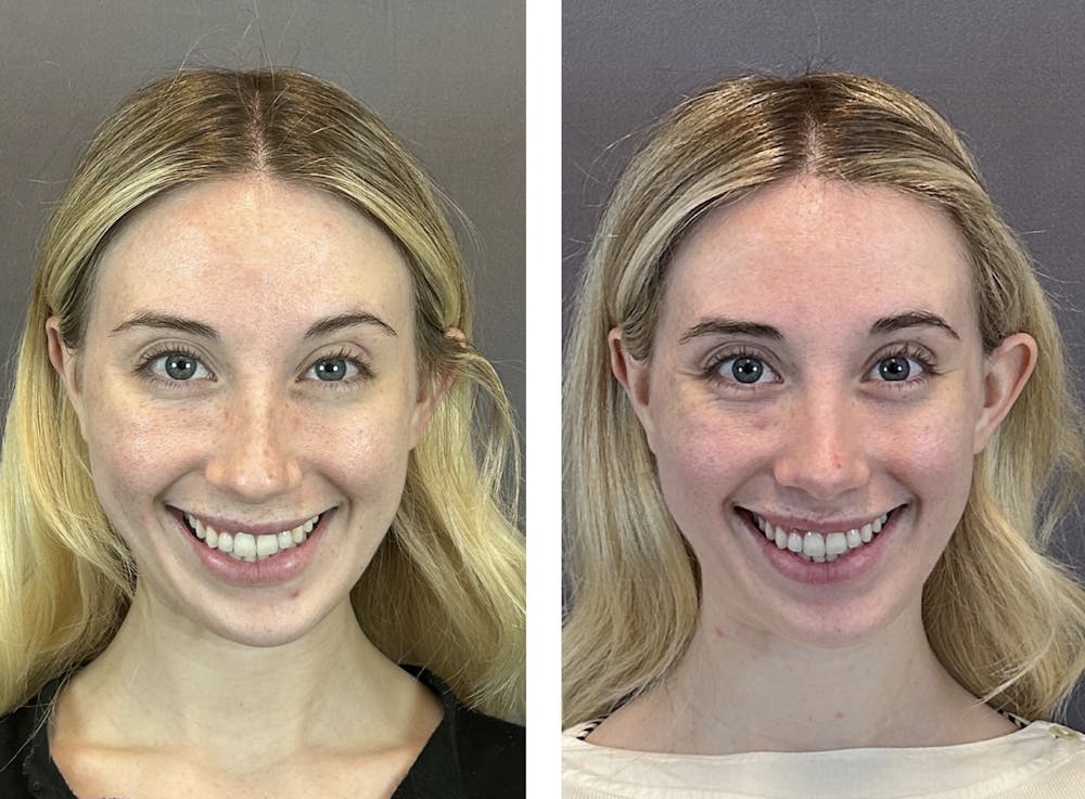 Rhinoplasty Before & After Gallery - Patient 152662238 - Image 3