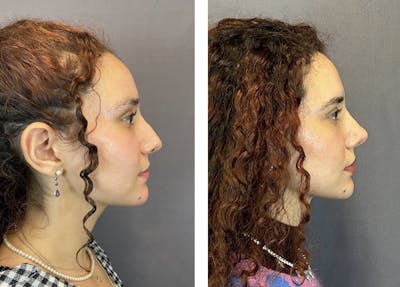 Rhinoplasty Before & After Gallery - Patient 152676526 - Image 1