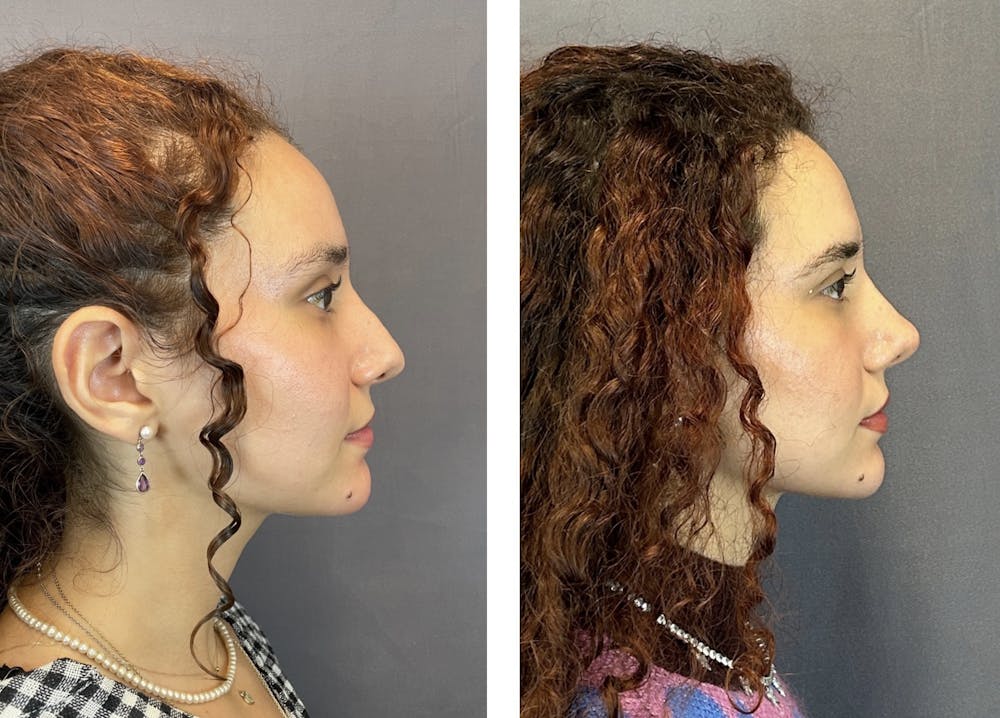 Rhinoplasty Before & After Gallery - Patient 152676526 - Image 1