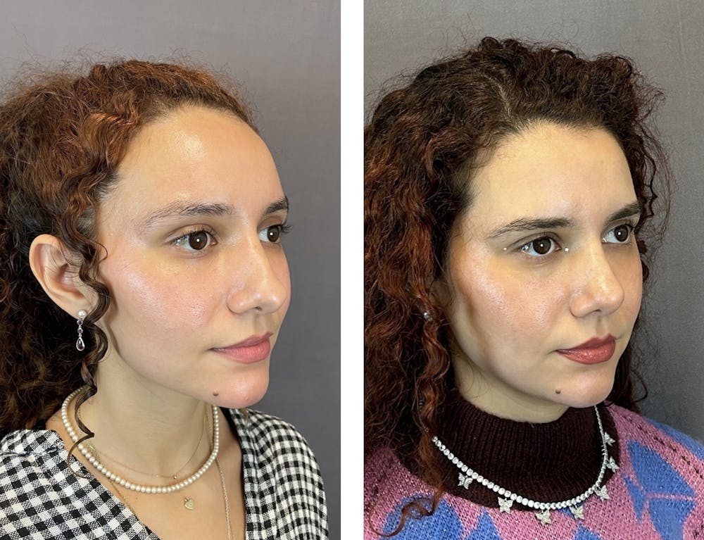 Rhinoplasty Before & After Gallery - Patient 152676526 - Image 2