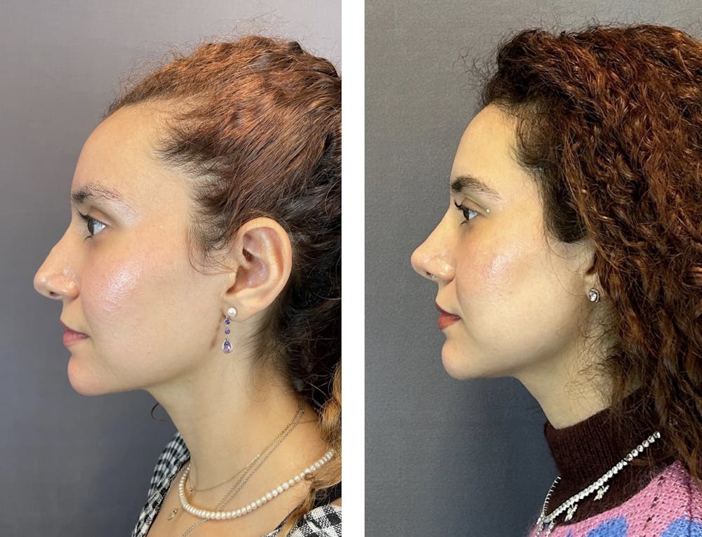 Rhinoplasty Before & After Gallery - Patient 152676526 - Image 5