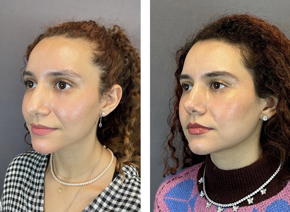 Rhinoplasty Before & After Gallery - Patient 152676526 - Image 4
