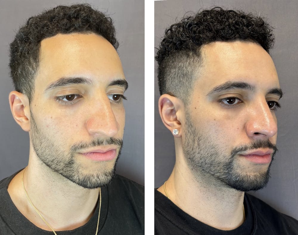 Rhinoplasty Before & After Gallery - Patient 152704996 - Image 2