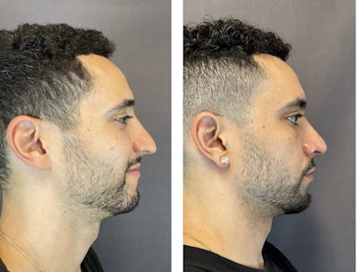 Rhinoplasty Before & After Gallery - Patient 152704996 - Image 1