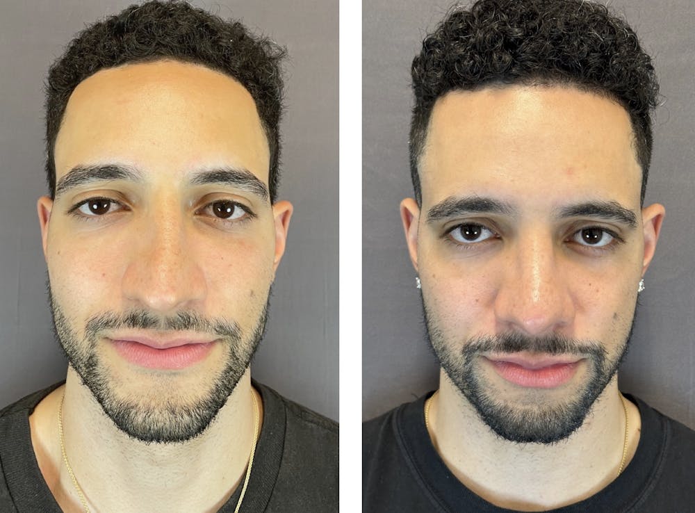 Rhinoplasty Before & After Gallery - Patient 152704996 - Image 3