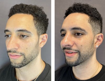 Rhinoplasty Before & After Gallery - Patient 152704996 - Image 4