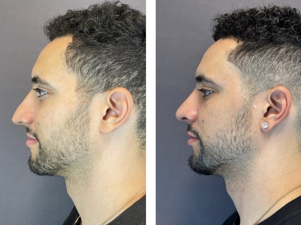 Rhinoplasty Before & After Gallery - Patient 152704996 - Image 5