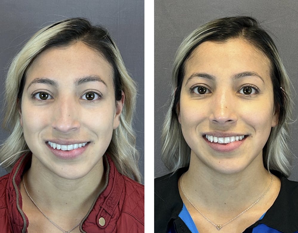 Rhinoplasty Before & After Gallery - Patient 152705000 - Image 3