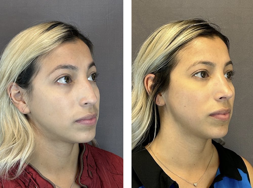 Rhinoplasty Before & After Gallery - Patient 152705000 - Image 2