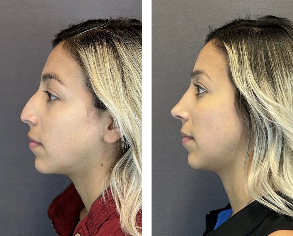 Rhinoplasty Before & After Gallery - Patient 152705000 - Image 5