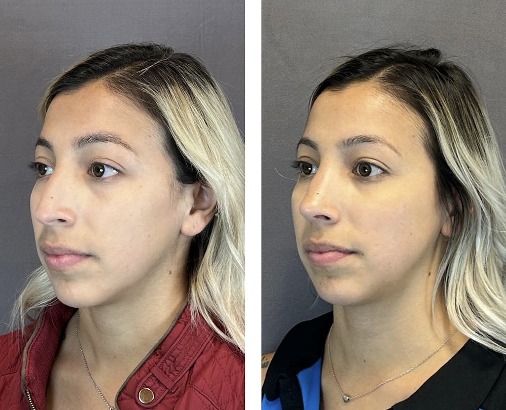 Rhinoplasty Before & After Gallery - Patient 152705000 - Image 4