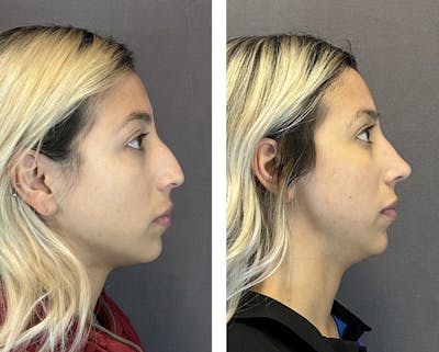 Rhinoplasty Before & After Gallery - Patient 152705000 - Image 1