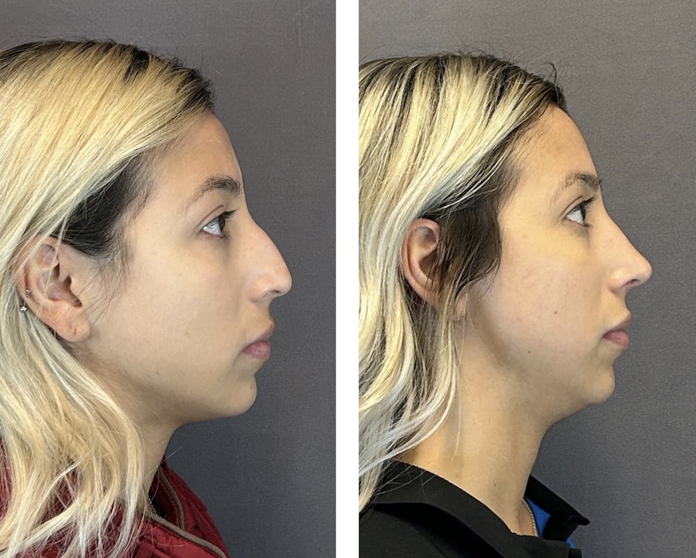 Rhinoplasty Before & After Gallery - Patient 152705000 - Image 1