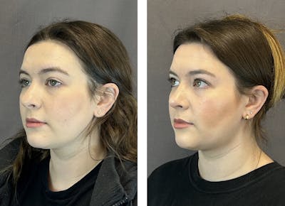 Rhinoplasty Before & After Gallery - Patient 152705002 - Image 4
