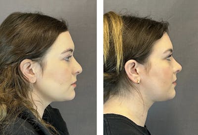 Rhinoplasty Before & After Gallery - Patient 152705002 - Image 1