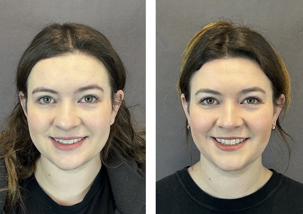 Rhinoplasty Before & After Gallery - Patient 152705002 - Image 3