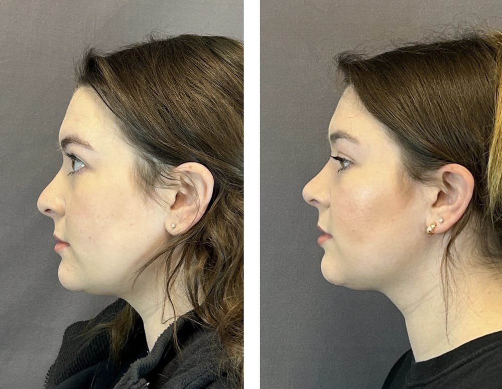 Rhinoplasty Before & After Gallery - Patient 152705002 - Image 5