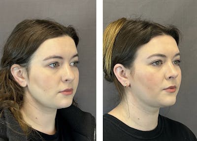 Rhinoplasty Before & After Gallery - Patient 152705002 - Image 2