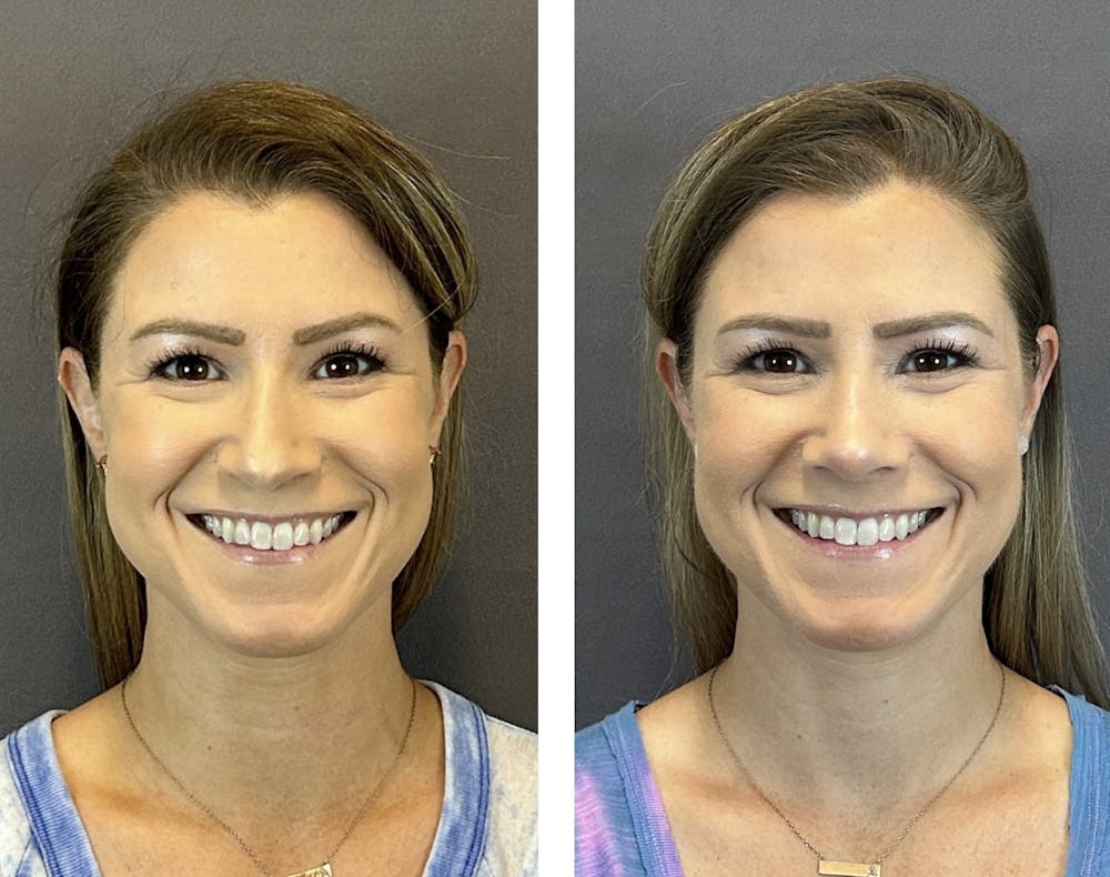 Rhinoplasty Before & After Gallery - Patient 152705004 - Image 3