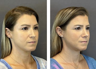 Rhinoplasty Before & After Gallery - Patient 152705004 - Image 2
