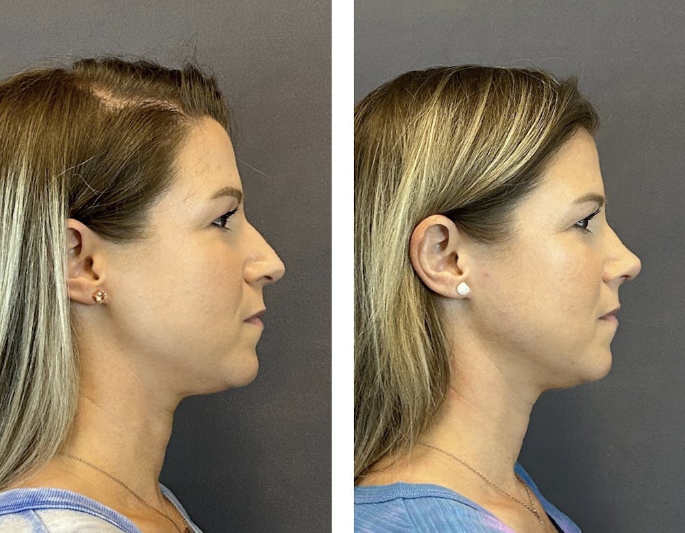 Rhinoplasty Before & After Gallery - Patient 152705004 - Image 1