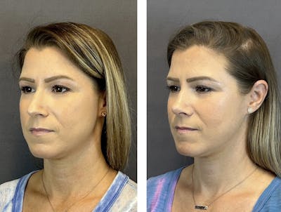 Rhinoplasty Before & After Gallery - Patient 152705004 - Image 4