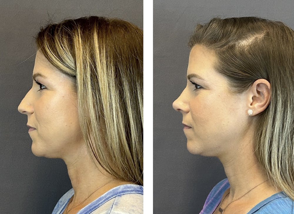 Rhinoplasty Before & After Gallery - Patient 152705004 - Image 5