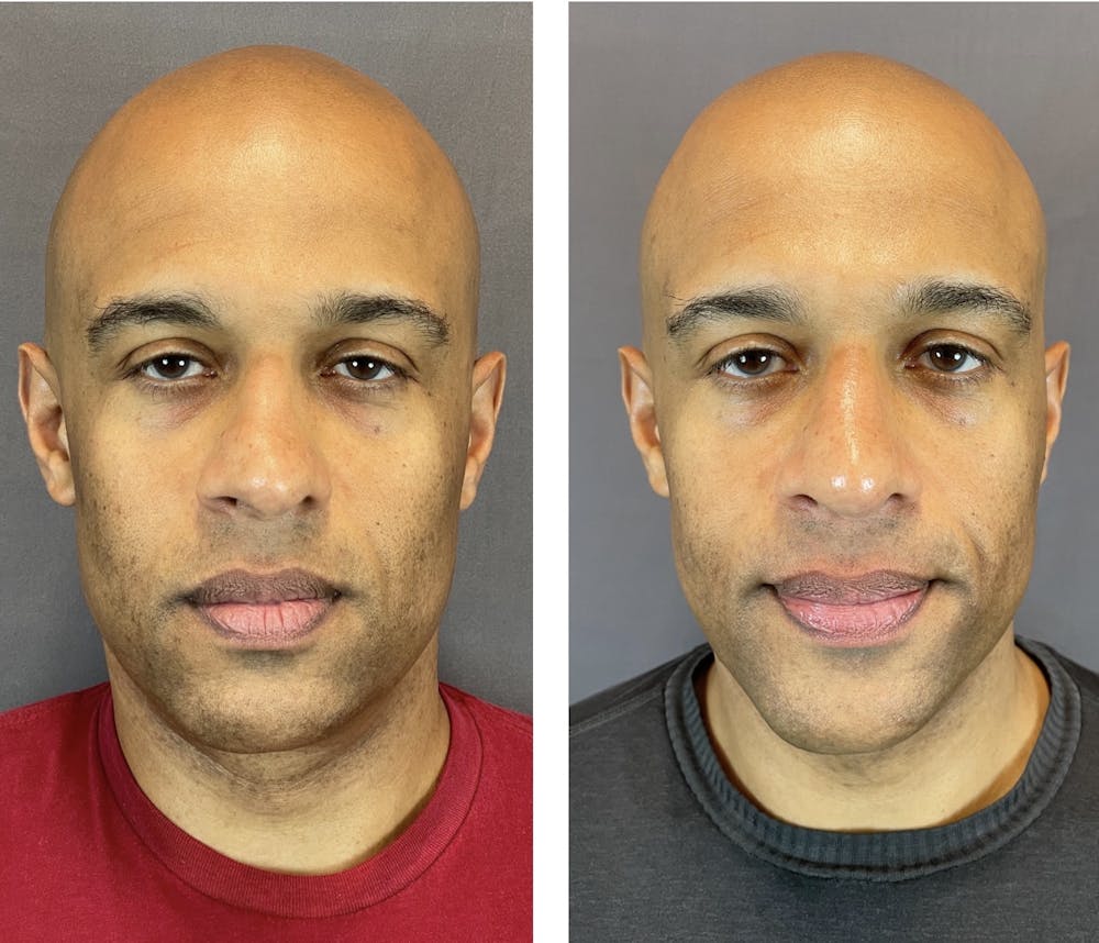 Rhinoplasty Before & After Gallery - Patient 152705003 - Image 3