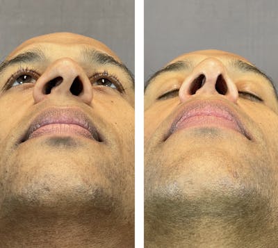 Rhinoplasty Before & After Gallery - Patient 152705003 - Image 4