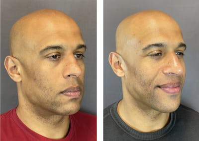 Rhinoplasty Before & After Gallery - Patient 152705003 - Image 2