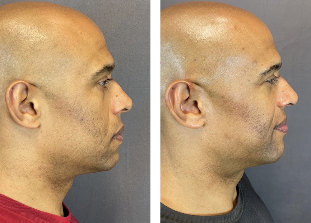 Rhinoplasty Before & After Gallery - Patient 152705003 - Image 1