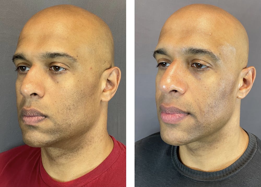 Rhinoplasty Before & After Gallery - Patient 152705003 - Image 5