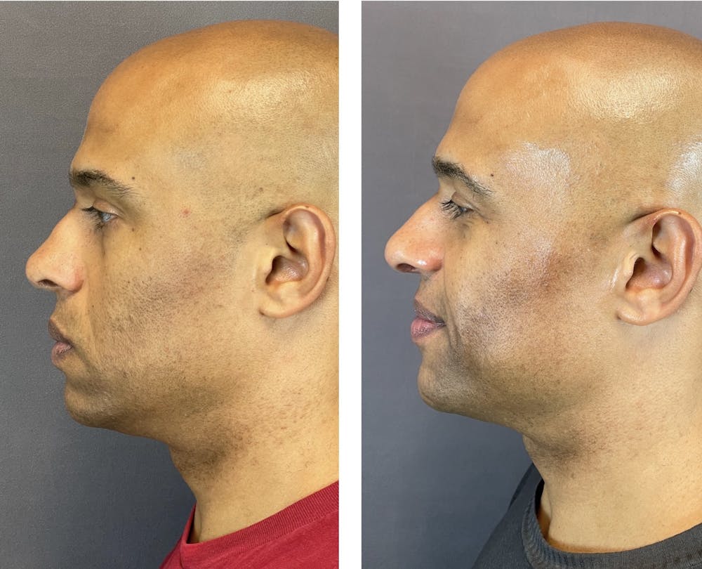 Rhinoplasty Before & After Gallery - Patient 152705003 - Image 6