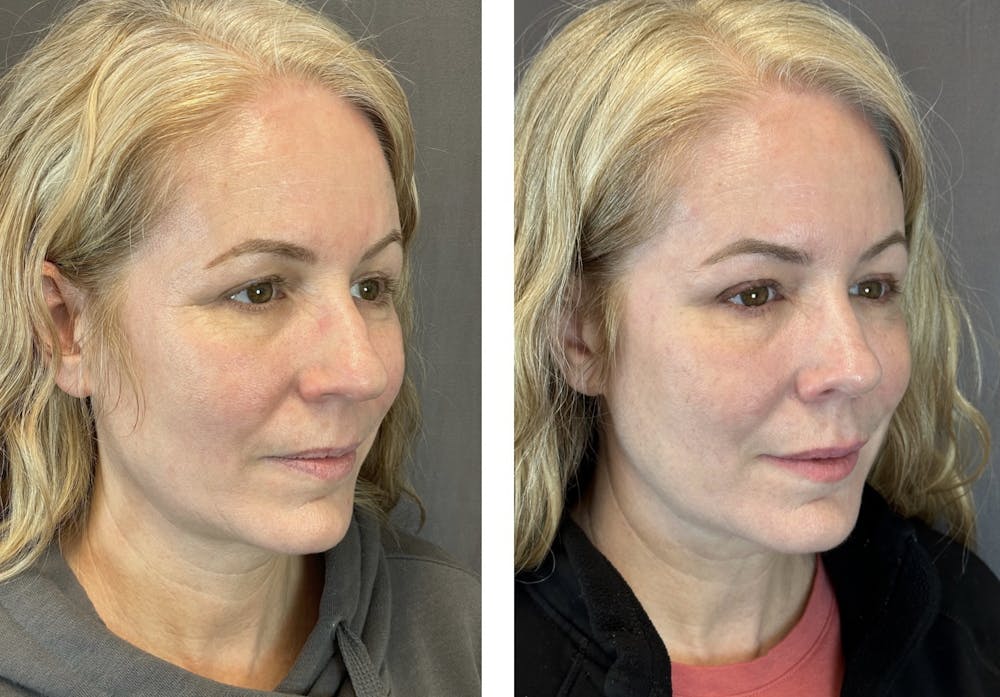 Rhinoplasty Before & After Gallery - Patient 152705028 - Image 2
