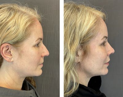 Rhinoplasty Before & After Gallery - Patient 152705028 - Image 1