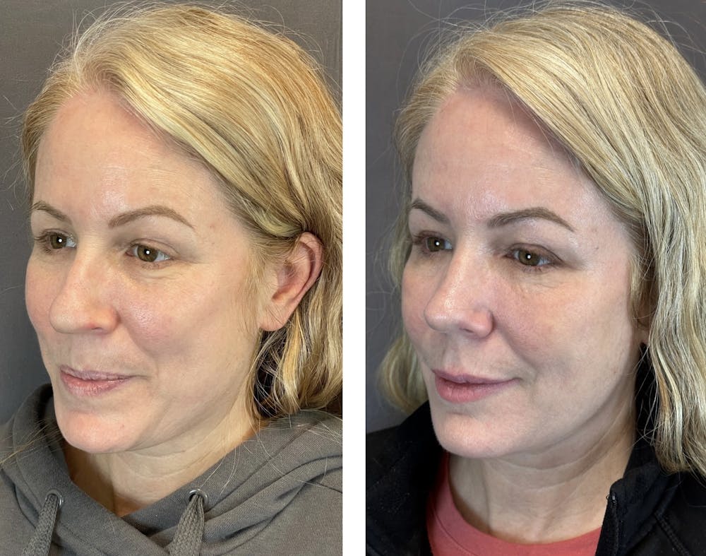 Rhinoplasty Before & After Gallery - Patient 152705028 - Image 4
