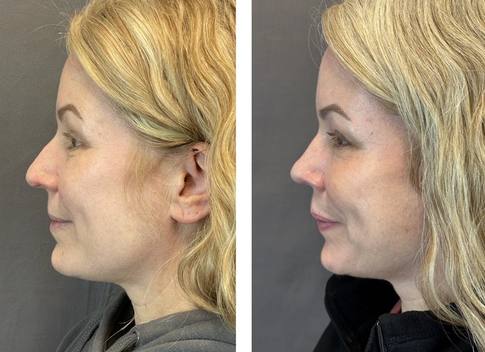 Rhinoplasty Before & After Gallery - Patient 152705028 - Image 5